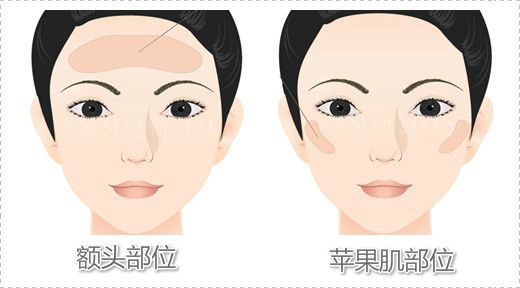 自体脂肪填充面部能解决什么问题？
