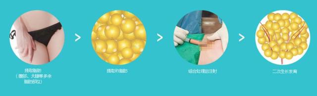 自体脂肪填充面部能解决什么问题？