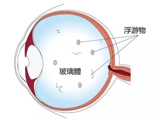 眼科医生写的“史上最强飞蚊症治疗攻略”，不得不看