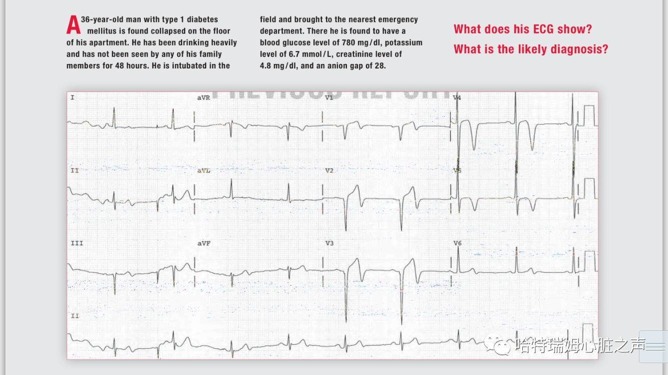 此心电图的非特异性T波改变你会如何诊断?