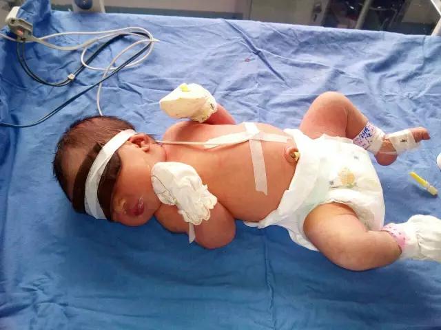 乐山沐川婴儿患Rh血型不合溶血病，市妇幼保健院成功手术救孩儿