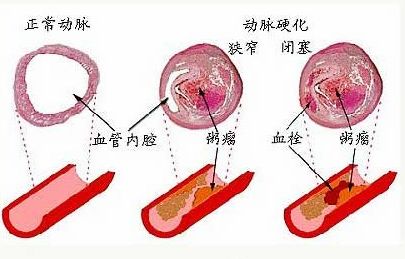 ​中风死亡概率高！知道这4点，九成悲剧可避免