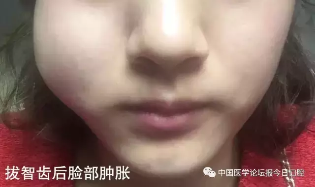医生 拔智齿后脸肿了 还张不开嘴 能恢复吗 健康 蛋蛋赞