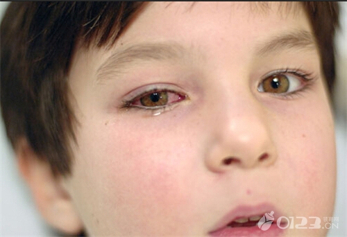 春季儿童红眼病高发 预防红眼病从洗手开始！