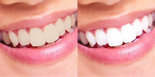冷光牙齿美白多少钱，冷光美白牙齿费用是多少？