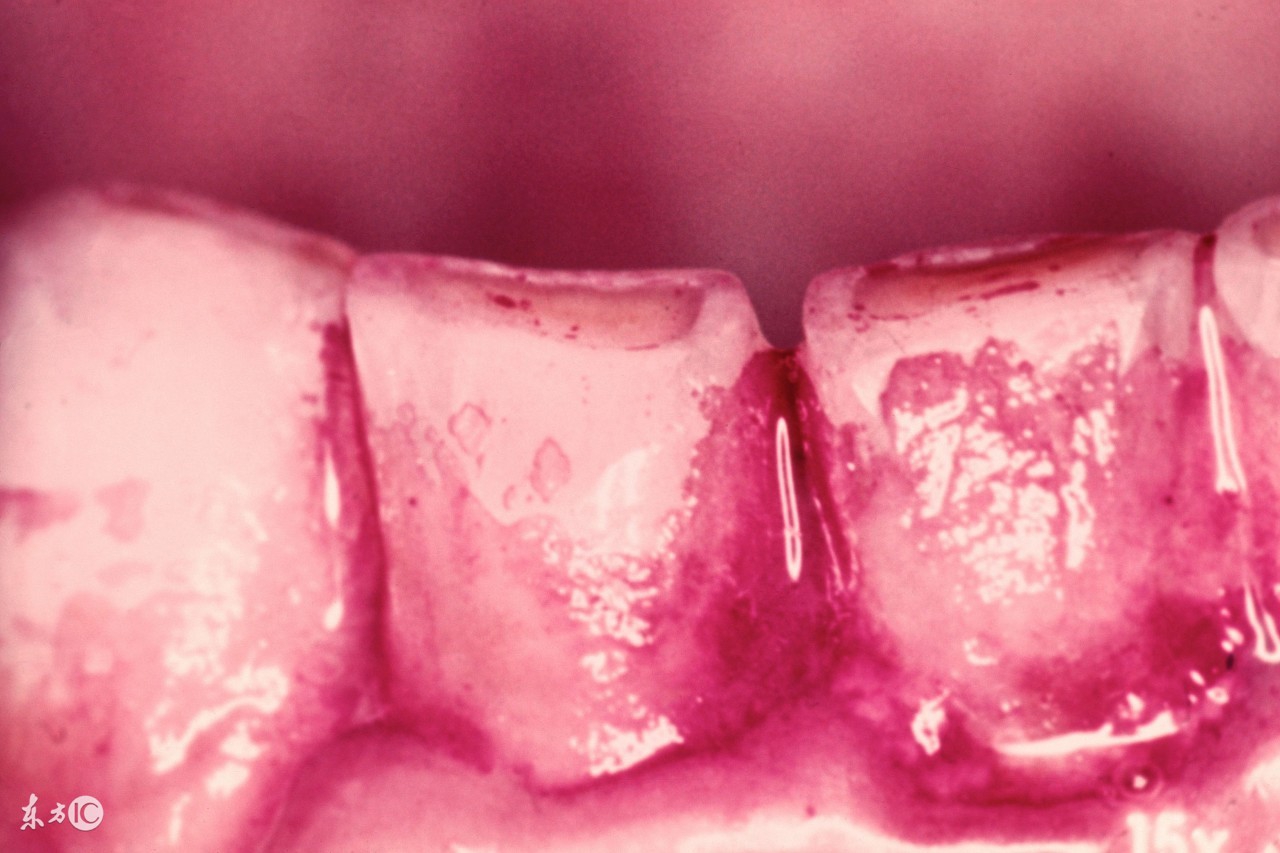 超声波洁牙的原理会不会伤牙？这回全部告诉你！