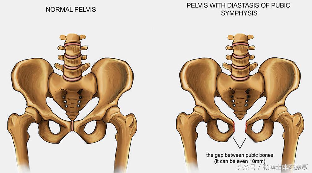 什么是耻骨联合分离症，耻骨联合分离产后多久可以恢复