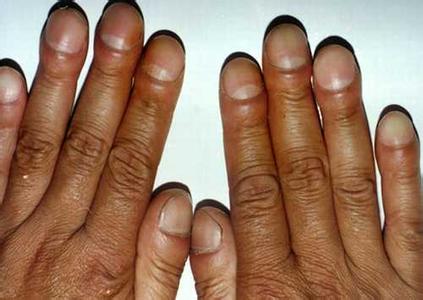 手指关节胀痛，既然是肺癌？！
