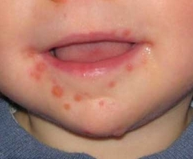 孩子嘴巴长疹子就一定是手足口？早期辨别很重要