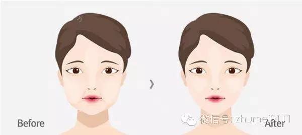 瘦脸方式与恢复时间：你想选择哪一种？