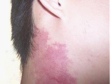 详细分析:脖子胎记算命图解,脖子上不一样