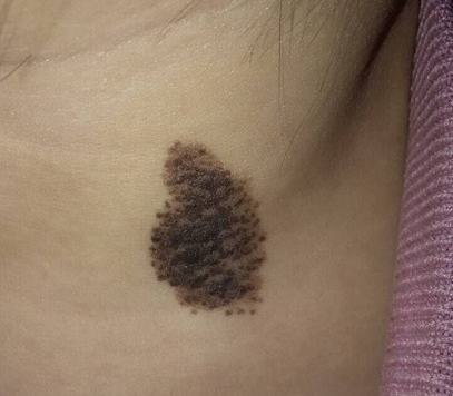 详细分析:脖子胎记算命图解,脖子上不一样