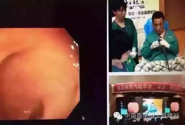 真牛！上海医生自己给自己做肠镜，现场直播！