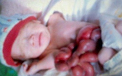 20周产检发现宝宝肠在体外，妈妈却坚持生下后奇迹生还