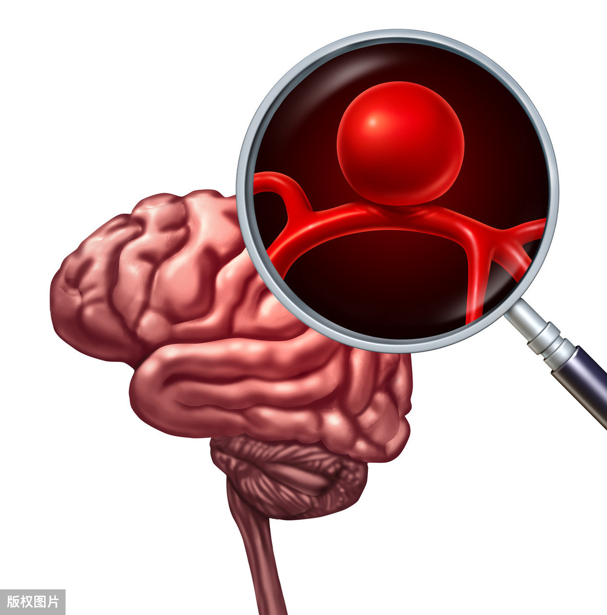 解剖变异与前交通复合体动脉瘤破裂出血后脑血管痉挛的关系