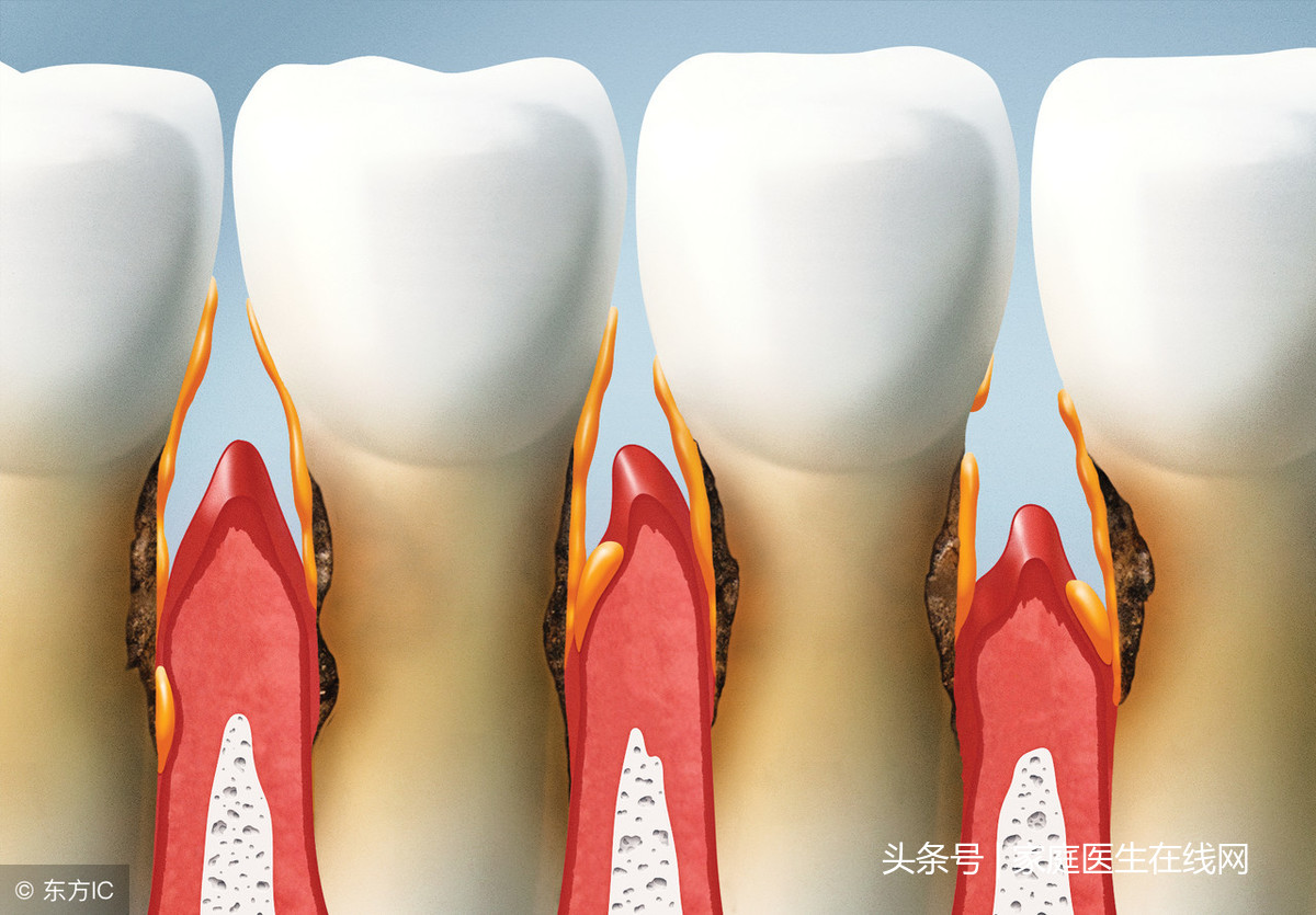 出现牙龈萎缩怎么办？真的无药可救了吗？医生终于说了大实话！