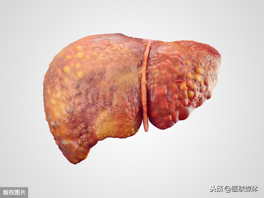 从酒精性脂肪肝发展到肝癌，或只有三步之遥，再不治疗就晚了
