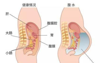 什么是腹腔积水？腹腔里为什么会有水？