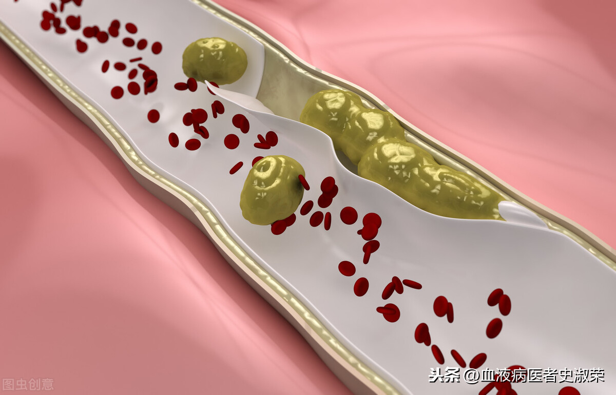 血小板增多發生出血血栓怎麼辦