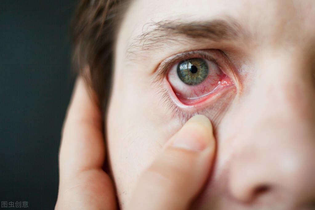 眼睛里出现红血丝严重吗？离不开5个因素，快速消除做好这些事