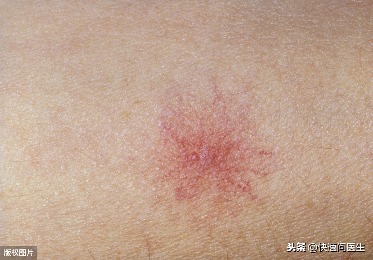 身上突然长了很多小红痣是什么原因？警惕：这两种痣