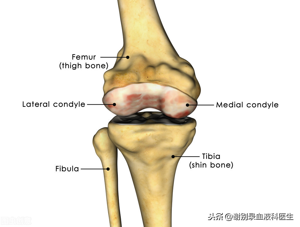 多發性骨髓瘤早期症狀有哪些