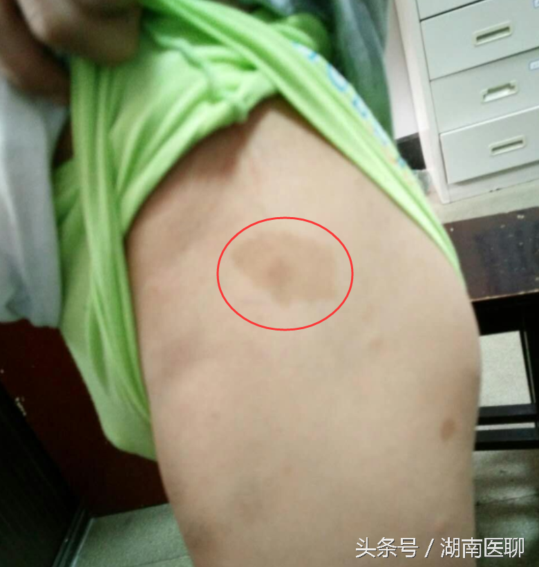 十岁男童胸背长咖啡色斑致右眼变形？罕见遗传病是祸首！