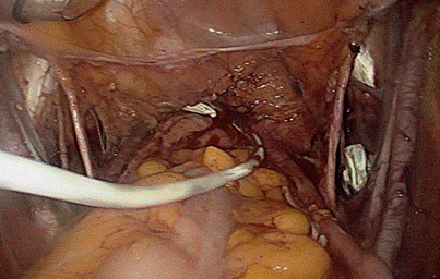 妇科肿瘤术后是否需要留置腹腔引流管？