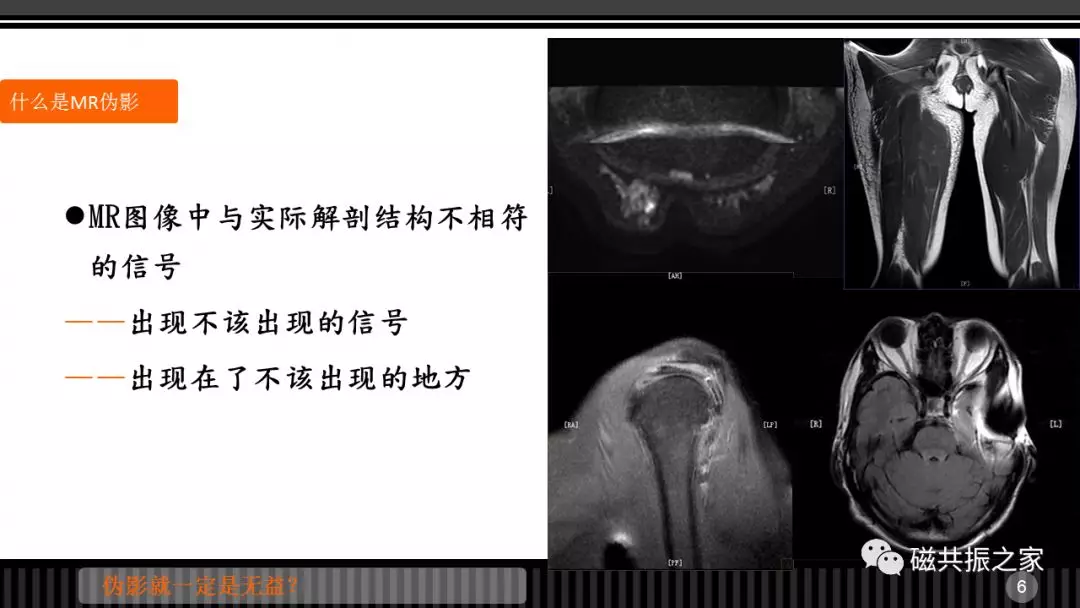 磁共振常见伪影及策略