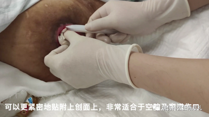 褥疮系列3：褥疮、窦道换药过程视频+图解