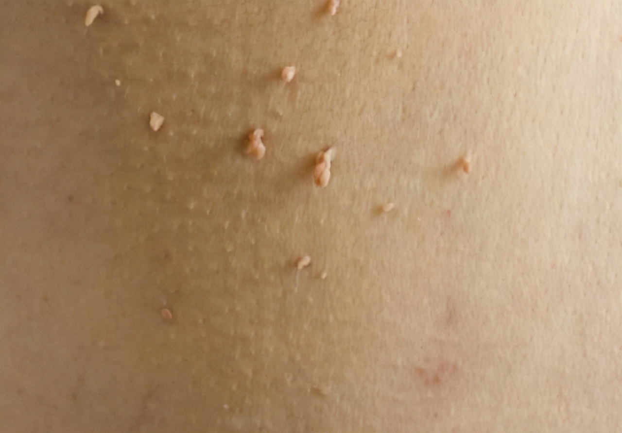 If you have HPV in your body, just look at it. People with HPV