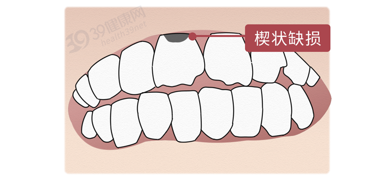 為什么有人總是睡覺磨牙？肚子里真的有蛔蟲？科學(xué)的解釋來了