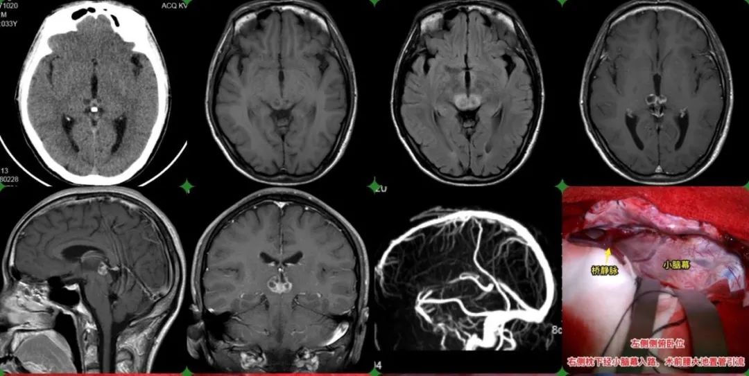 Zhaotong man's vision is blurry and double vision, the test results