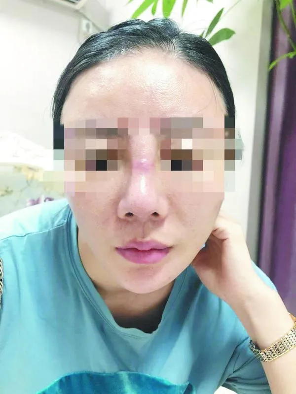 女子隆鼻失败后感染溃烂 南昌婕熹卡医疗美容遭投诉