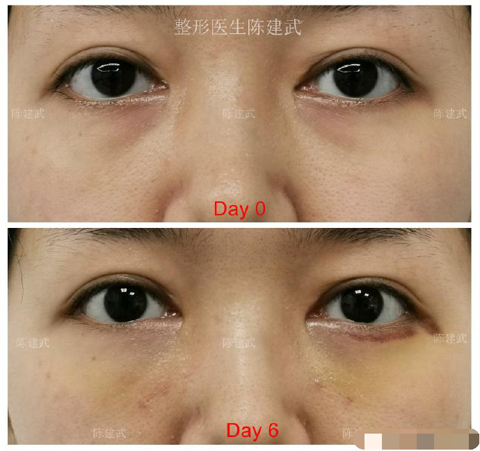 做完内切眼袋手术后 突然出血是正常的吗 看完你就明白了 整形医生陈建武 Mdeditor