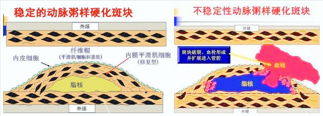 新冠疫苗接种，“捕获”了一大批高血压患者！这是最高的1例