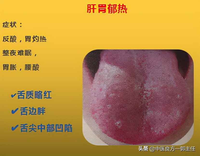 12 kinds of "heat" are hidden in the body, and the tongue and symptoms