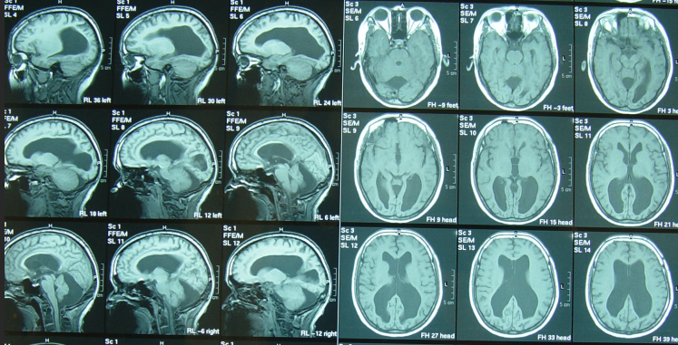 后颅窝枕大池蛛网膜囊肿,脑积水分流术后颅内感染,右侧肢体和头部震颤