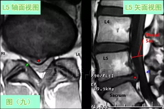 手把手教你：腰椎间盘突出CT和MRI读片技巧