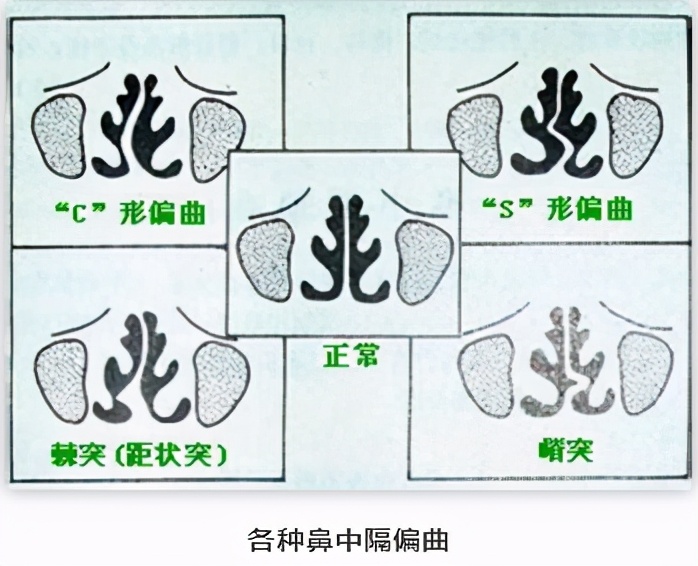 鼻中隔矫正手术会让鼻子扁塌吗 鼻中隔偏曲 鼻中隔偏曲