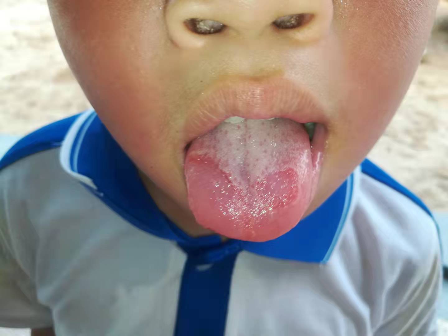 Talk about zinc deficiency and map tongue iNEWS