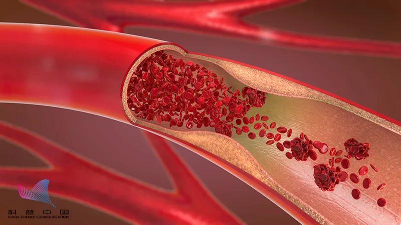 血管裡有垃圾，定期輸液通血管？ 醫生：這些做法坑你沒商量�