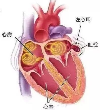 人到中年，如何避免脑梗死，做到三个坚决，让你生活更健康