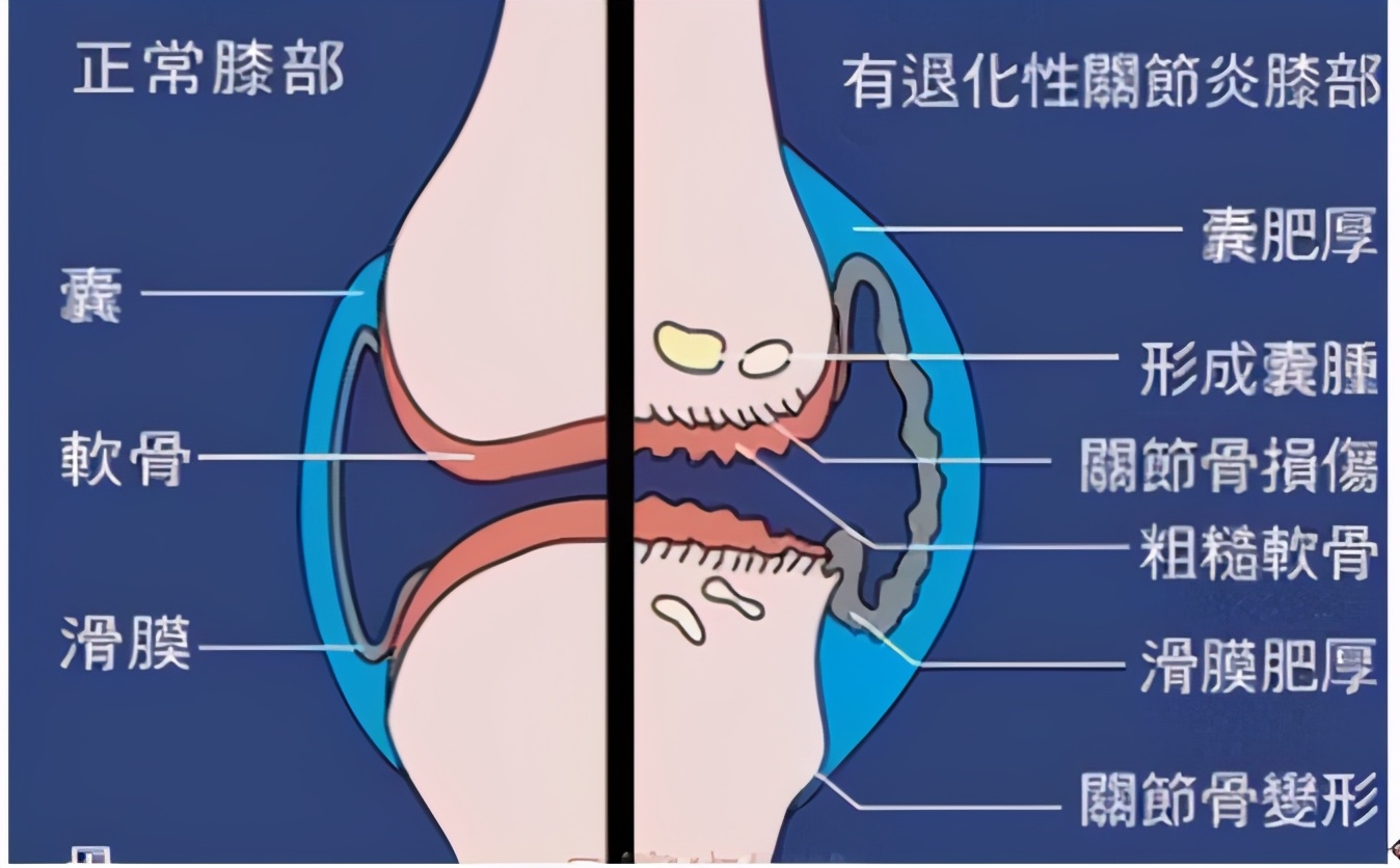 Knee pain when it rains?TCM teaches you 2 movements, stick to it every