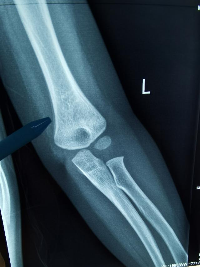 5岁小儿,肘部的肱骨髁上无明显移位 !--haodf:8:guzhe-->骨折 !