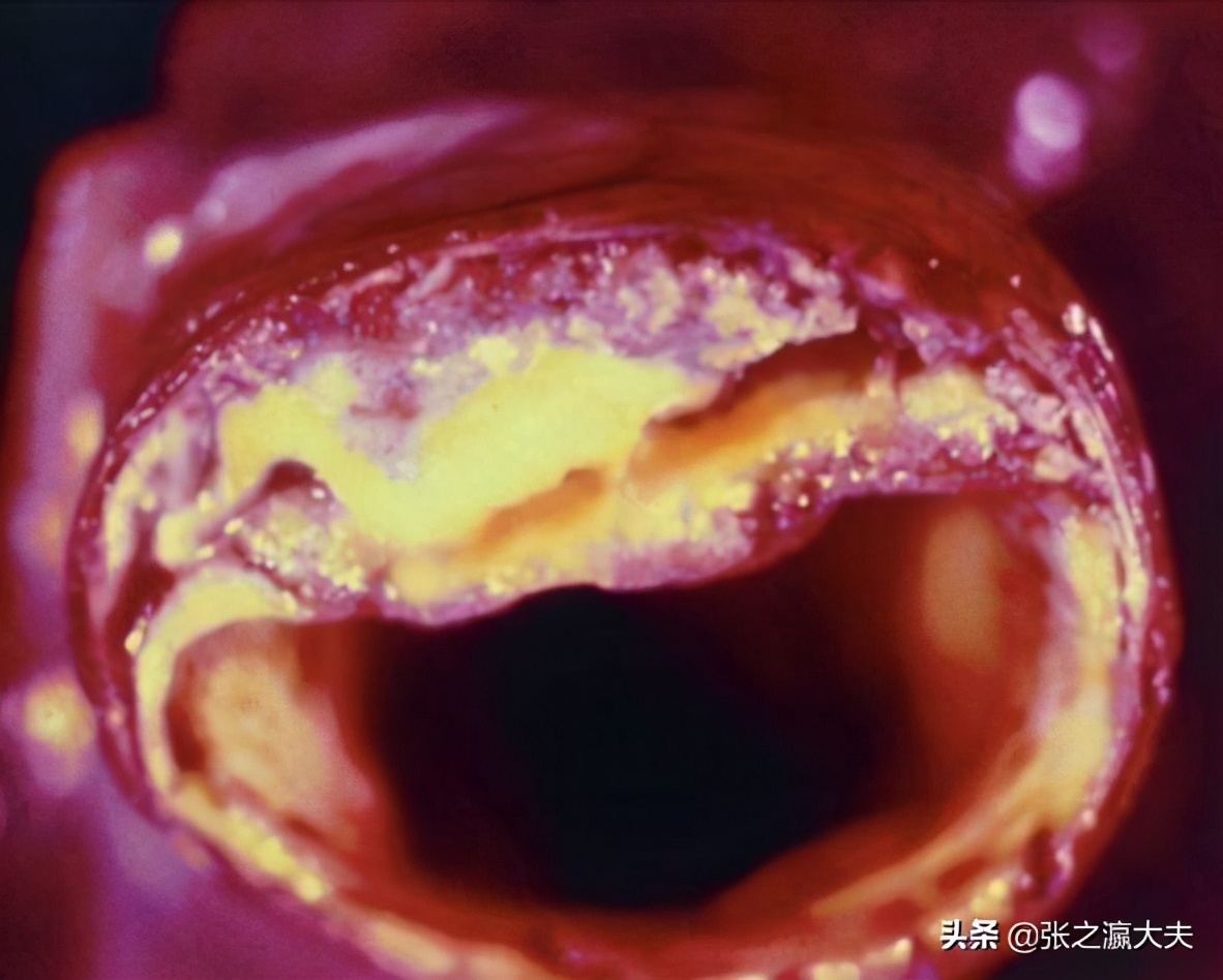 美國總統病逝，導致最大醫學研究出爐：沒有膽固醇，就沒有​​冠心病