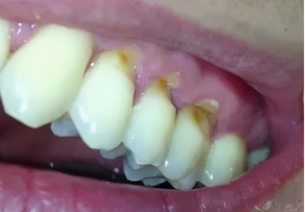 牙齿会越刷越糟吗？专家提醒：学习正确的刷牙方法更重要