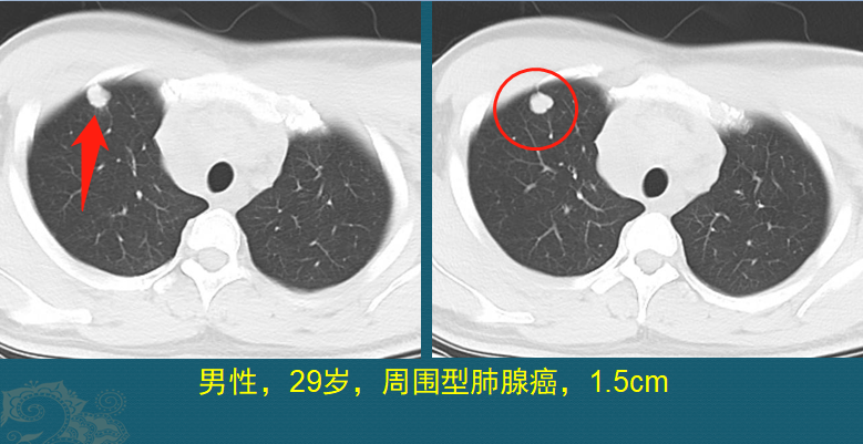 肺癌复发和转移的原因是什么？医生用2个病例，指导正确防癌