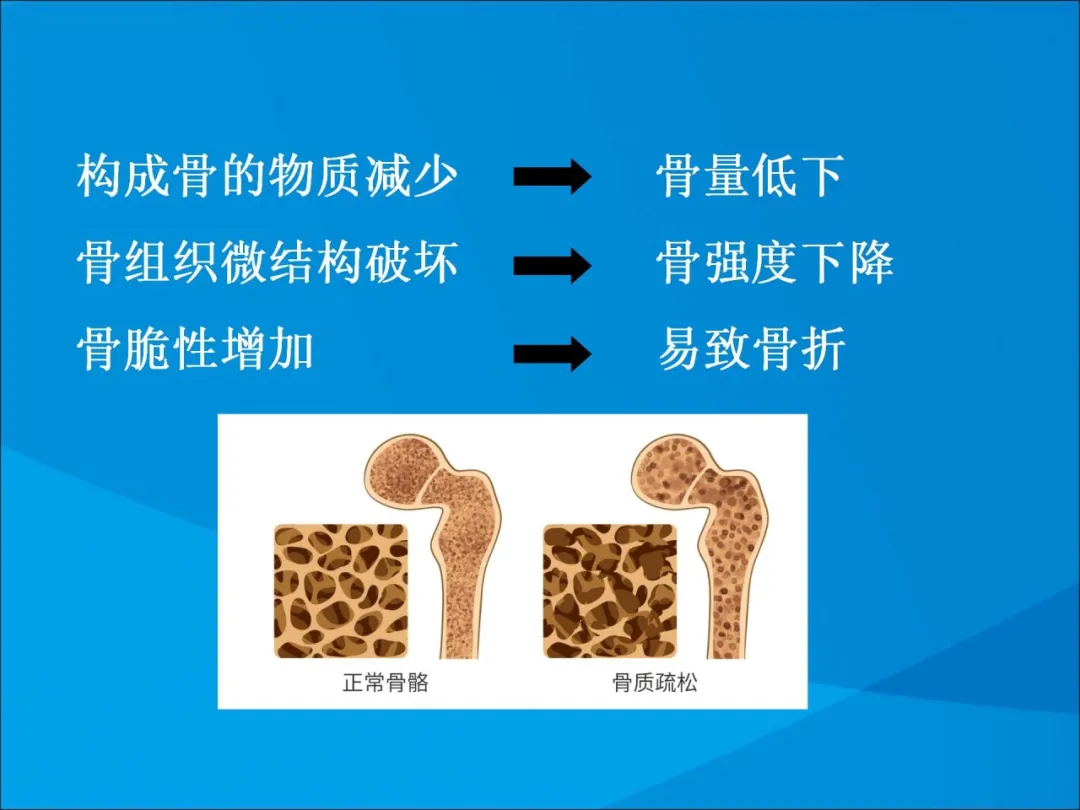 健康科普大赛获奖作品展示②|骨质疏松症的康复治疗