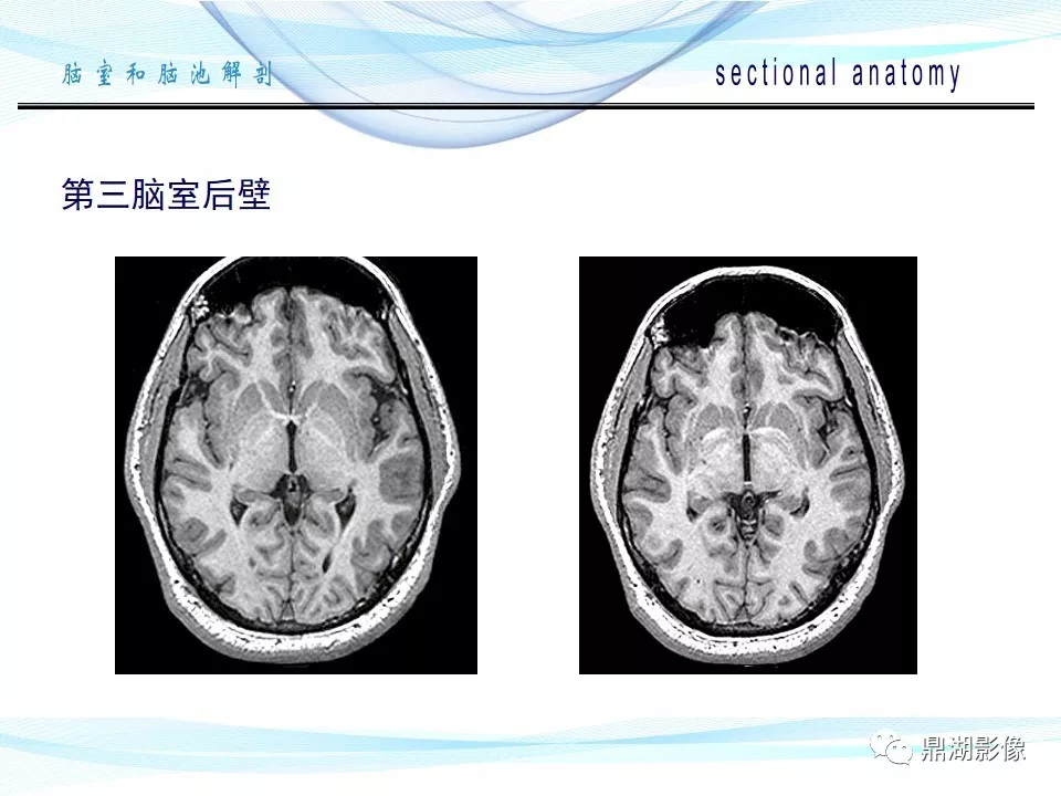 超全详解：脑池和脑室断层解剖